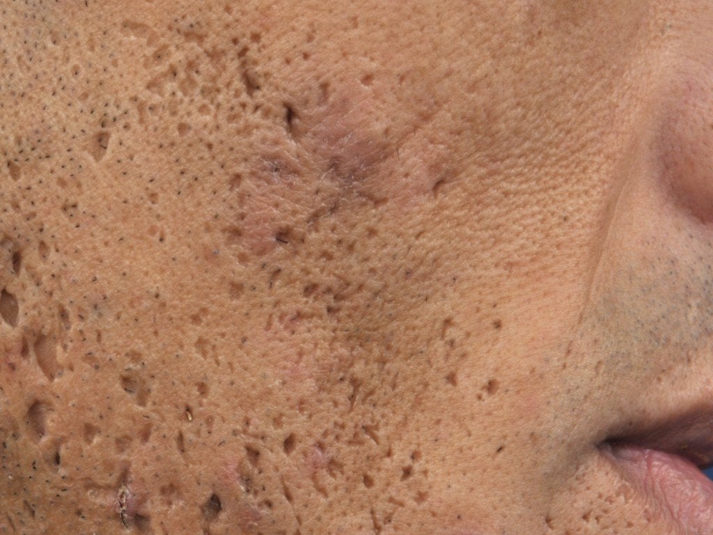 Apply These 5 Secret Techniques To Improve Fungal Acne Apply These 5 Secret Techniques To Improve Fungal Acne