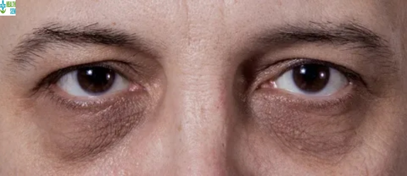 The Truth About Depression Dark Circles Eye -And What You Can Do About Them Depression Dark Circles Eye