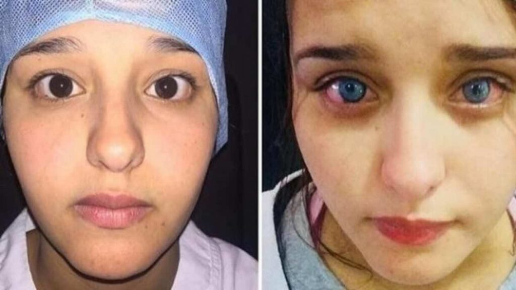 What is Eye color change surgery