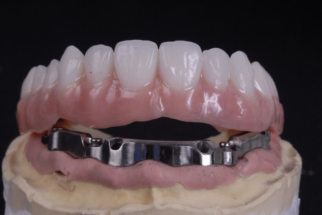 Have You Heard of All-On-Four Implants?