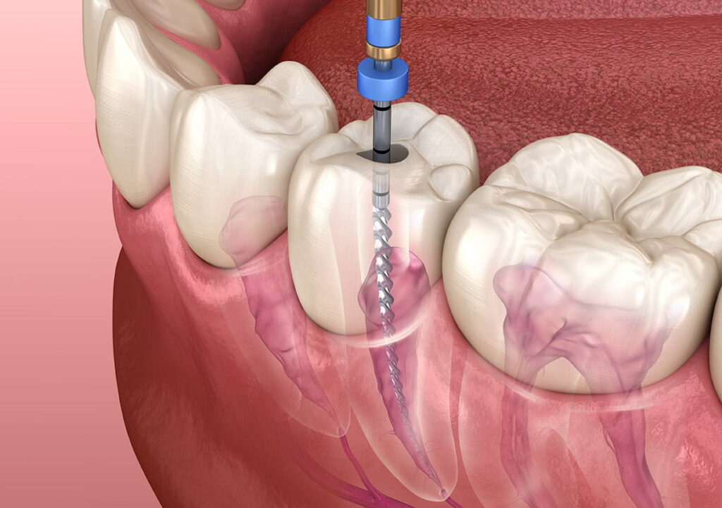 Tips for Managing Pain After a Root Canal Treatment