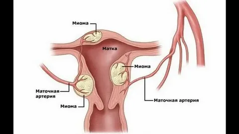 How Fast Can a Fibroid Grow?