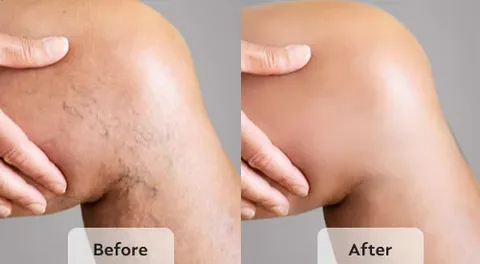 Effective Treatment for Varicose Veins in Spring, TX