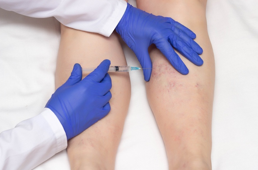 How Vein Sclerotherapy Eliminates Spider Veins Through Non-Invasive Treatment Solutions